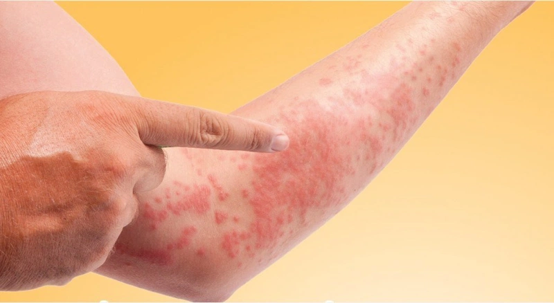 Những điều cần biết về thuốc dị ứng zyzocete
