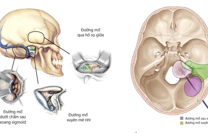 Những điều cần biết về u dây thần kinh số 8. Chi phí phẫu thuật u dây thần kinh số 8 hết bao nhiêu?3