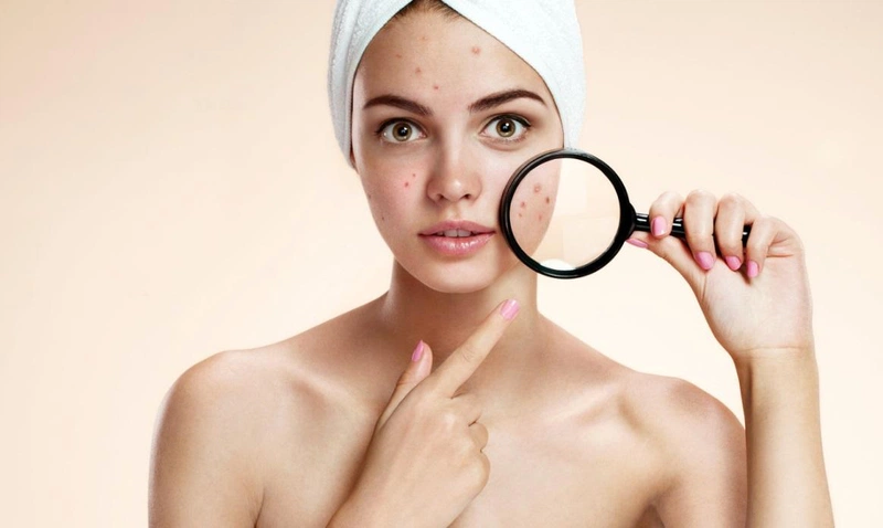 Những điều cần lưu ý khi tẩy trang cho da dầu mụn 1
