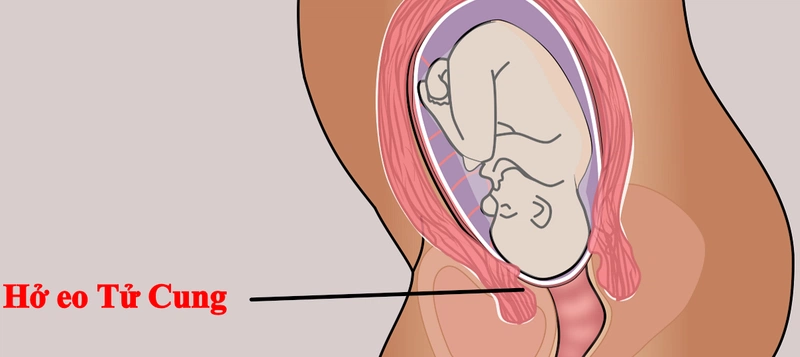 Những điều quan trọng thai phụ cần biết về khâu vòng cổ tử cung 2