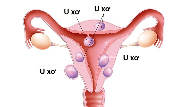 Những đối tượng dễ bị u xơ tử cung giai đoạn 4 và phương pháp điều trị? 1