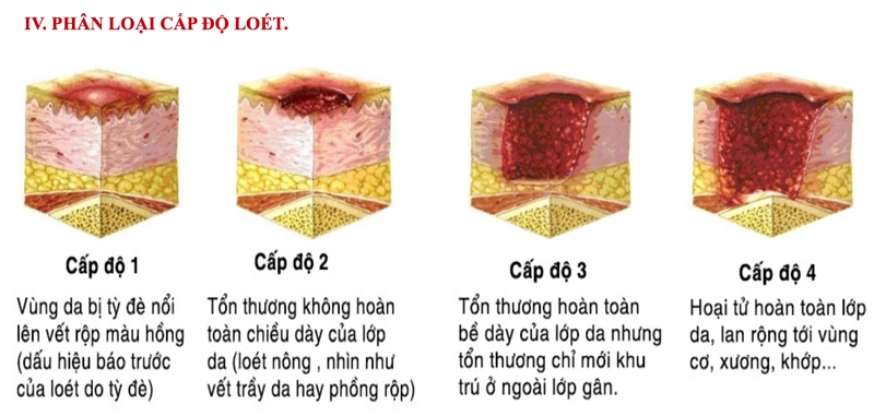 Những đối tượng nào dễ bị loét tì đè ở người cao tuổi?