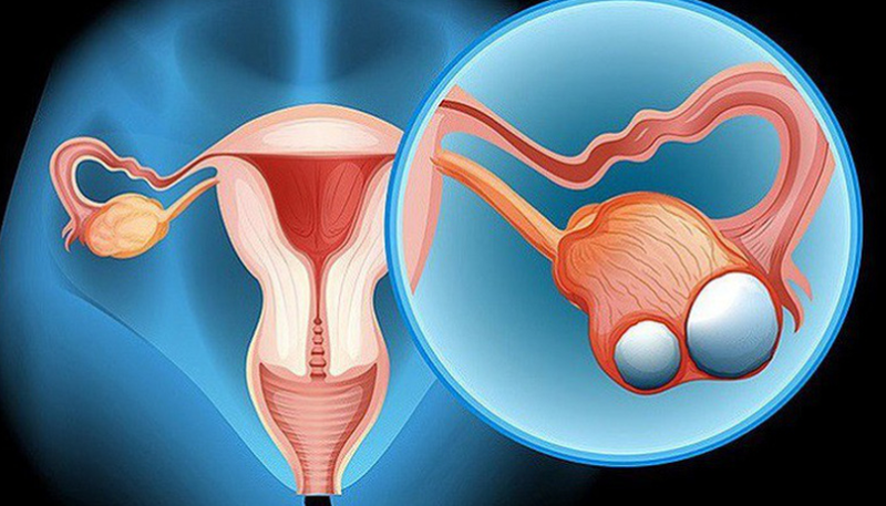 Những giai đoạn của bệnh ung thư buồng trứng 2