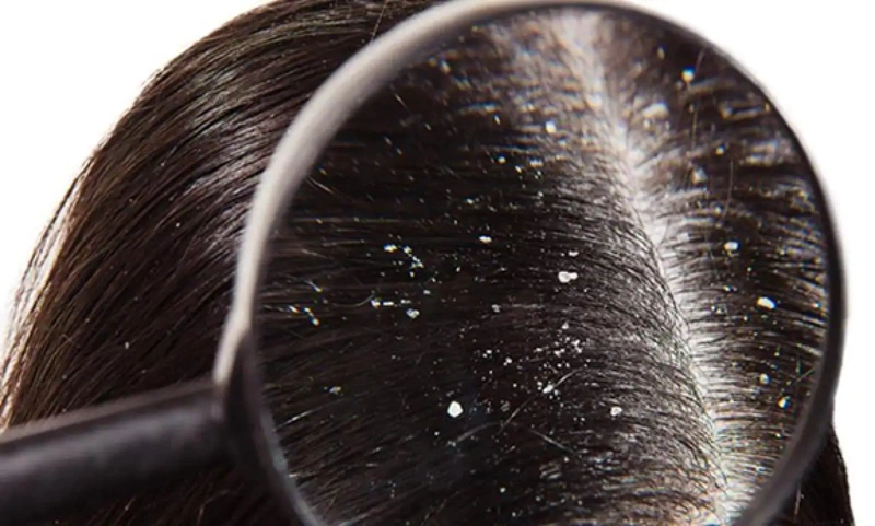 Những lưu ý bạn cần biết khi da đầu xuất hiện tình trạng gàu - Nhà thuốc  FPT Long Châu