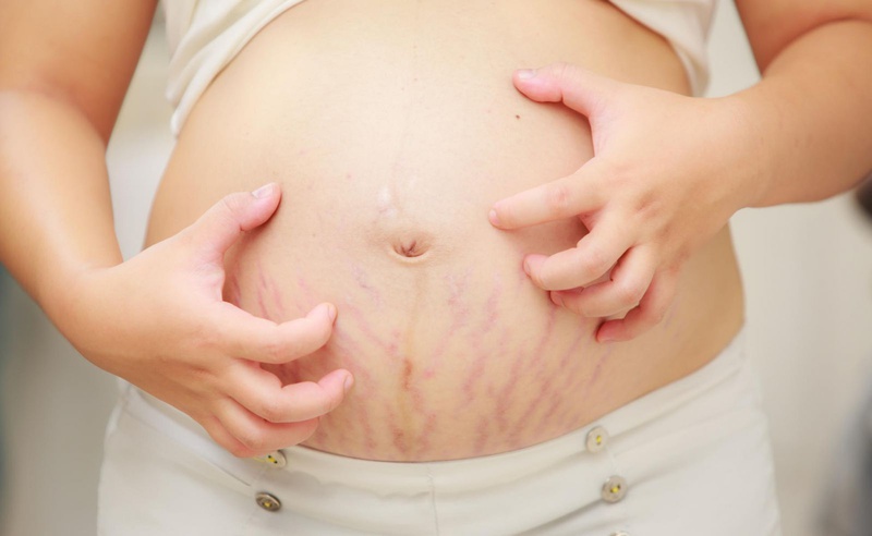 Mức độ rạn da ở các mẹ bầu là khác nhau