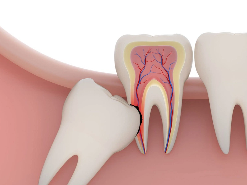 Nhổ răng khôn xong nên làm gì để giảm đau nhức? 1