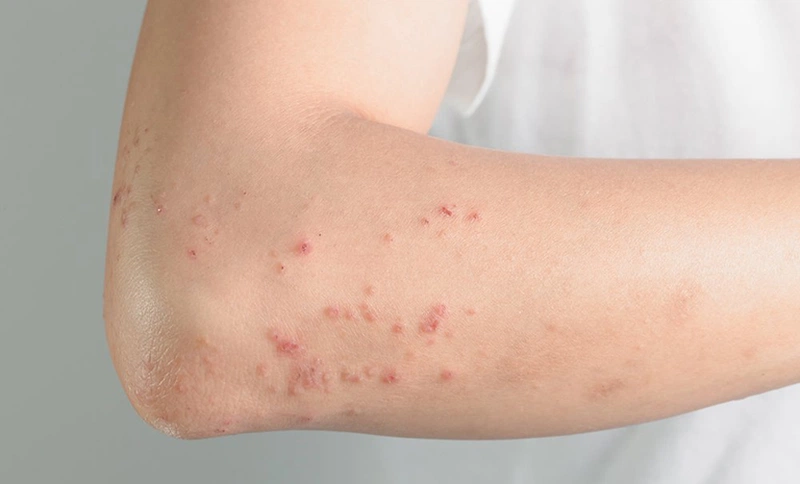 Những lưu ý khi triệt lông bằng laser có thể bạn chưa biết