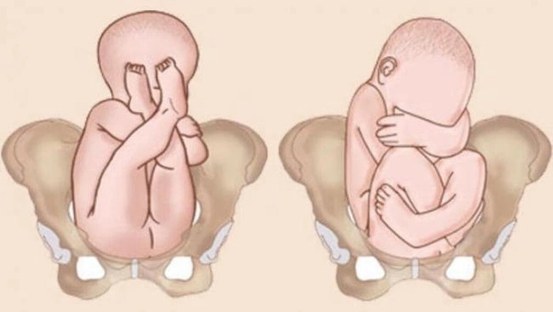 Những nguyên nhân khiến thai nhi không quay đầu mà các mẹ nên biết 1