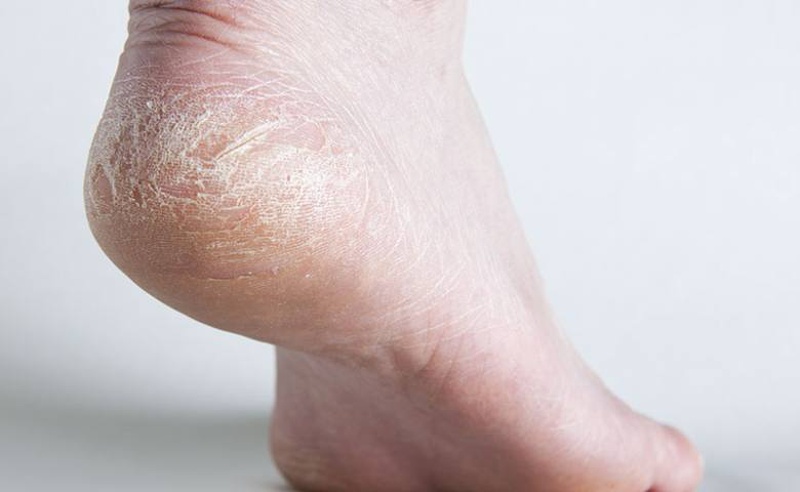 Những nguyên nhân nứt gót chân phổ biến bạn biết chưa? 1