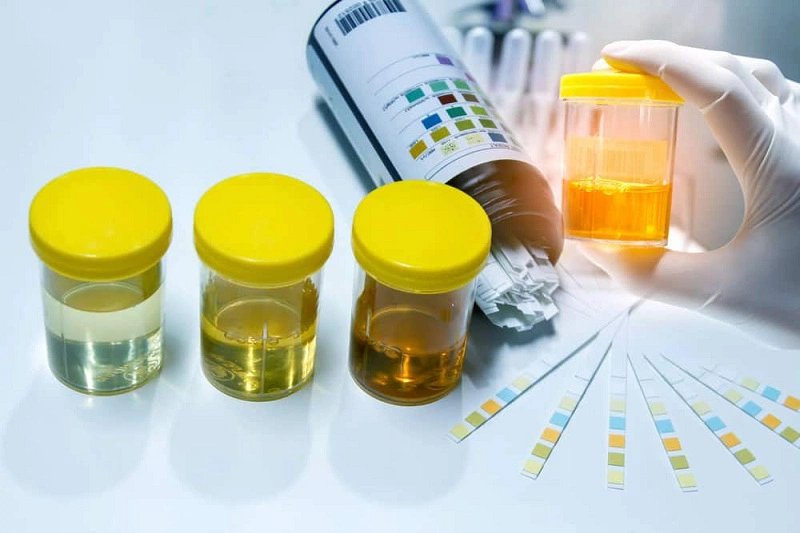 Những phương pháp xét nghiệm ma túy trong nước tiểu và máu-3
