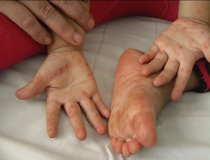 Những sai lầm trong việc điều trị trẻ bị tay chân miệng 1