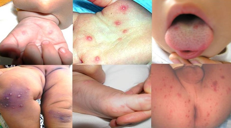 Những sai lầm trong việc điều trị trẻ bị tay chân miệng 3