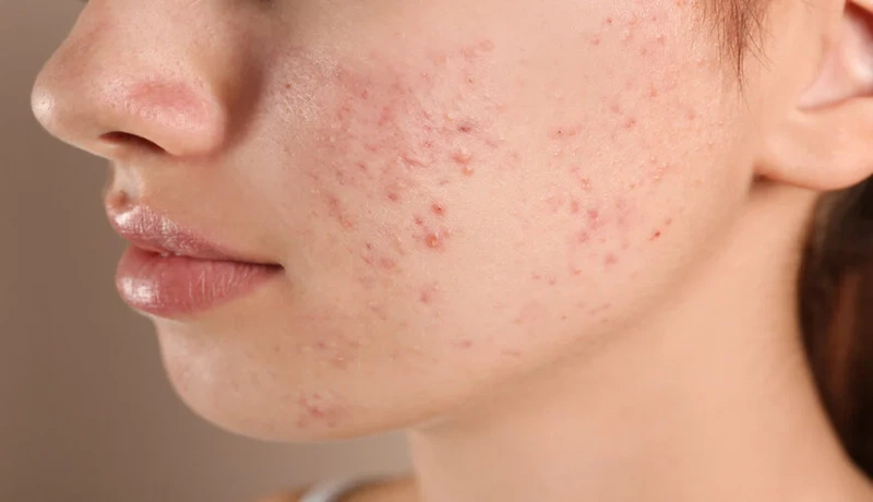 Những tác hại của corticoid trên da mà bạn nên biết 1