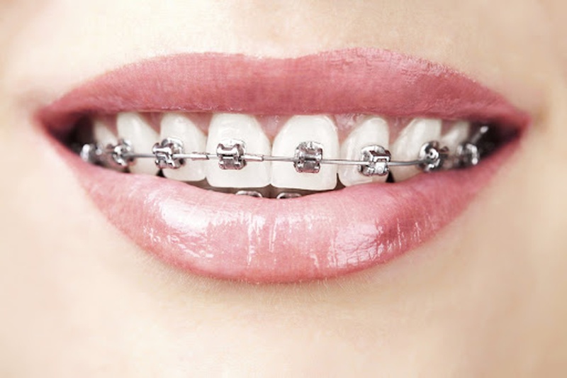 Những thông tin bạn cần biết về niềng răng kiêng ăn gì?