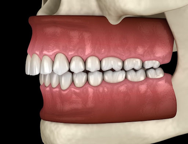 Những thông tin chia sẻ về vấn đề niềng răng lệch khớp cắn mà bạn cần quan tâm 1