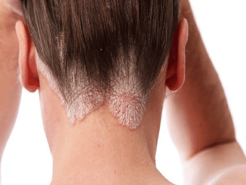 Những thông tin có thể bạn chưa biết về chứng đau da đầu1