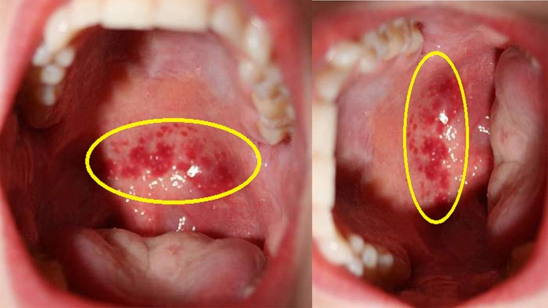 Những triệu chứng viêm họng hạt bạn cần nắm rõ để nhận biết bệnh 1