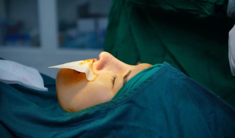 Những trường hợp không được nâng mũi bạn cần biết 3