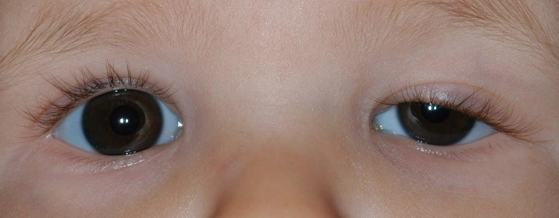 Nhược thị có nên đeo kính không? 1
