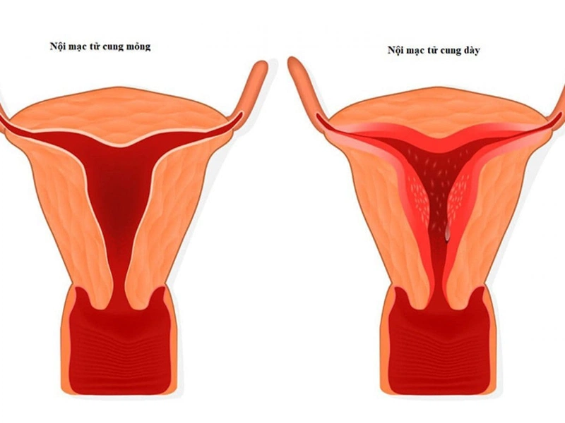 Niêm mạc tử cung dày bao nhiêu thì có thai? Cách cải thiện niêm mạc? 2