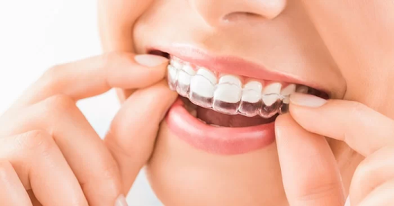 Thế nào là niềng răng 3D Clear? Ưu điểm của phương pháp này là gì? 1