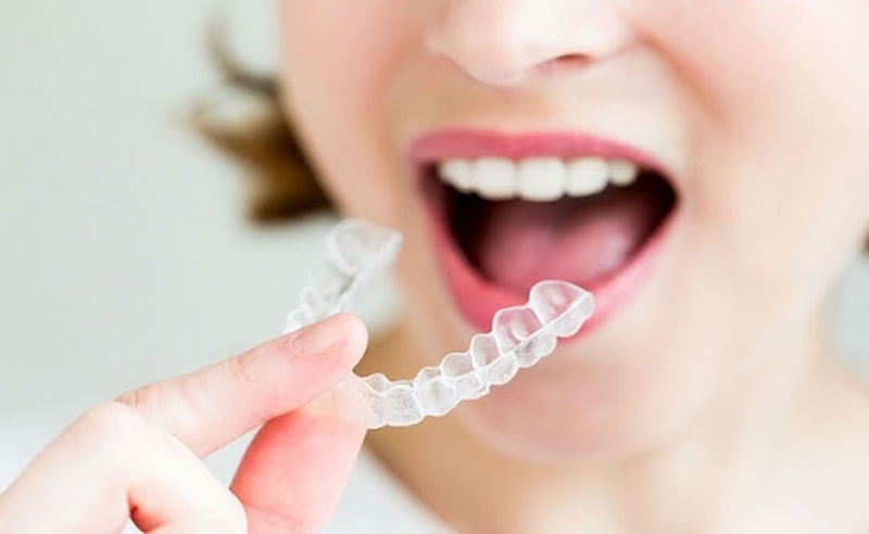 Niềng răng 3D clear là gì có hiệu quả hay không 2