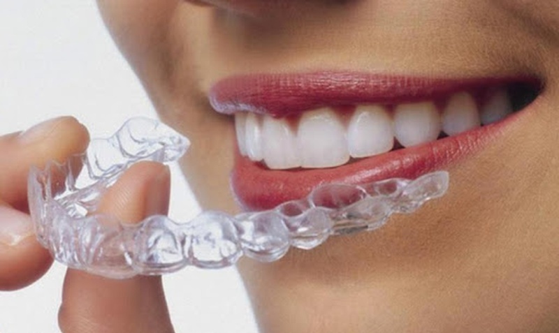 Niềng răng 3D clear là gì có hiệu quả hay không 3