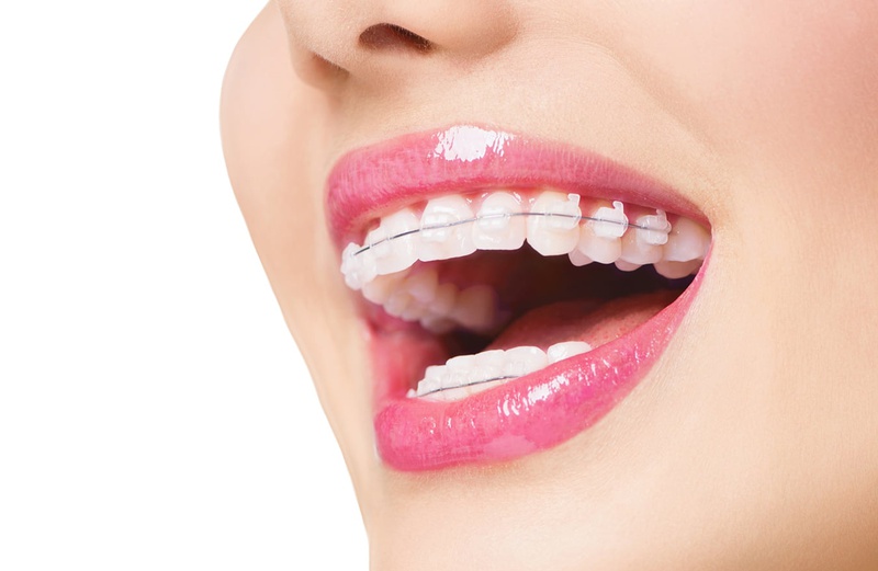 Mỗi kỹ thuật niềng răng cũng như vật liệu niềng, tính thẩm mỹ, kỹ thuật niềng, dịch vụ nha khoa,... đều ảnh hưởng đáng kể đến chi phí niềng răng