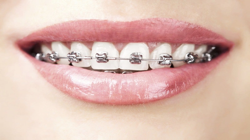 Niềng răng với mắc cài kim loại là phương pháp phổ biến nhất