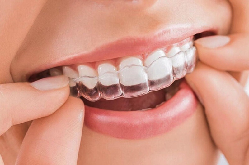 Giá tiền niềng răng trong suốt Invisalign tương đối cao