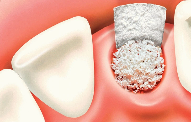 Niềng răng bị tiêu xương nguyên nhân do đâu? Cách khắc phục ra sao?1
