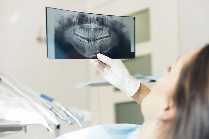 Niềng răng bị tiêu xương nguyên nhân do đâu? Cách khắc phục ra sao?3
