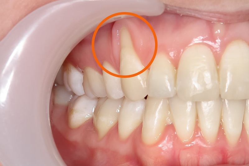 Niềng răng bị tụt lợi nguyên nhân do đâu? Cách khắc phục1