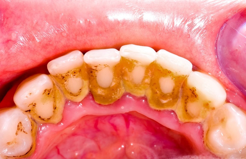 Niềng răng bị tụt lợi nguyên nhân do đâu? Cách khắc phục2