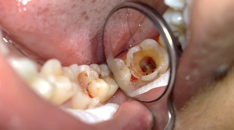 Niềng răng có ảnh hưởng gì không? Tác hại tiềm ẩn nào có thể xảy ra? 3