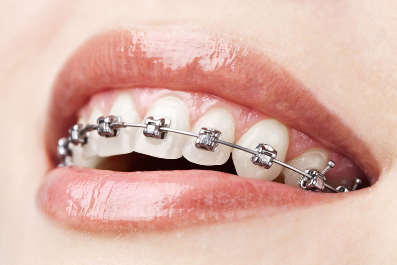 Niềng răng có cần phải nhổ răng không và có ảnh hưởng gì không 1