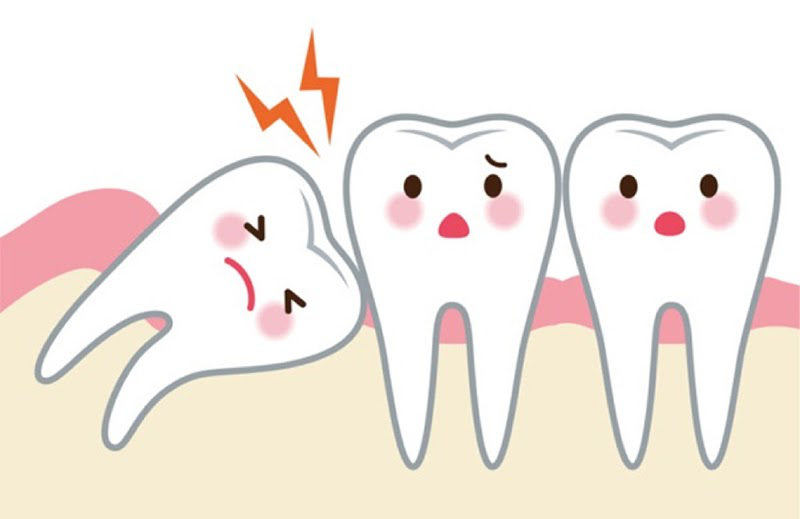 Niềng răng có cần phải nhổ răng không và có ảnh hưởng gì không 2