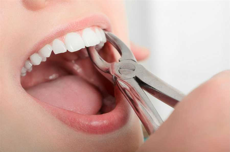 Niềng răng có cần phải nhổ răng không và có ảnh hưởng gì không 3