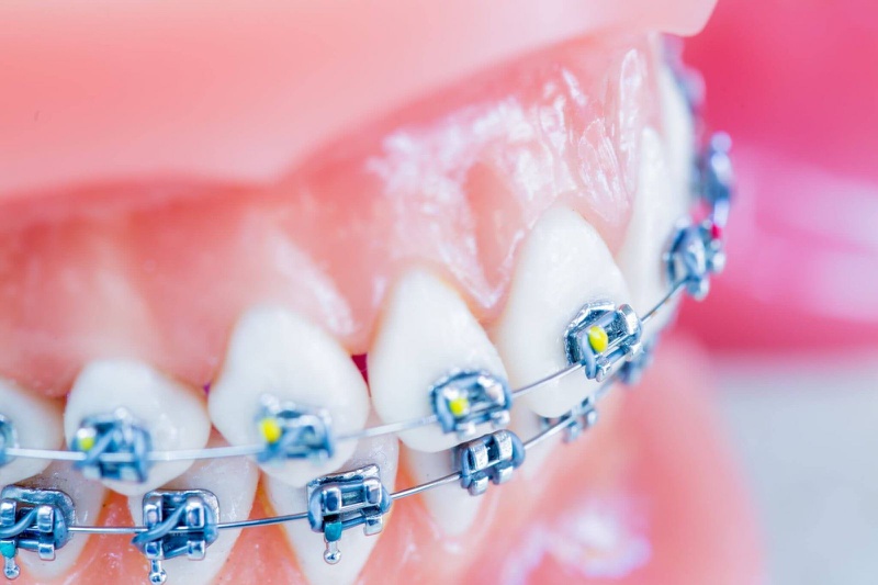 Giải đáp niềng răng có đau không 3