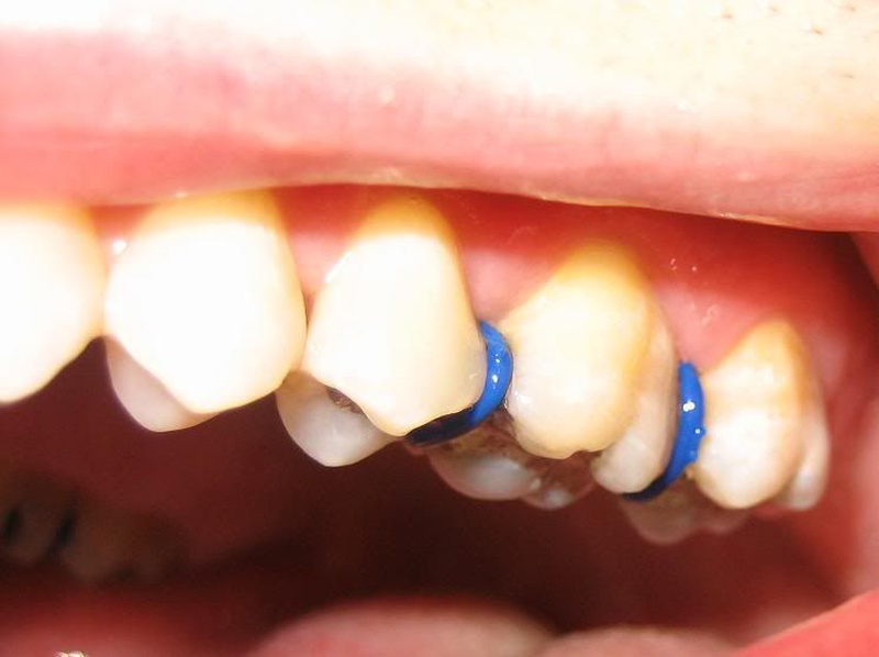 Niềng răng có đau không và giai đoạn nào là đau nhất 2