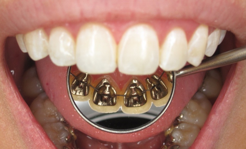 Liệu khi đeo niềng răng có hôn được không 2
