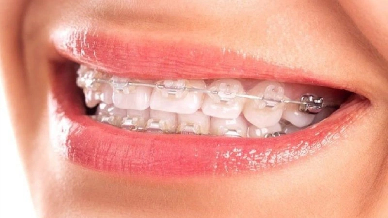 Niềng răng có cải thiện được tình trạng cằm lẹm không thì phải dựa trên nguyên nhân và tình trạng cụ thể của từng người