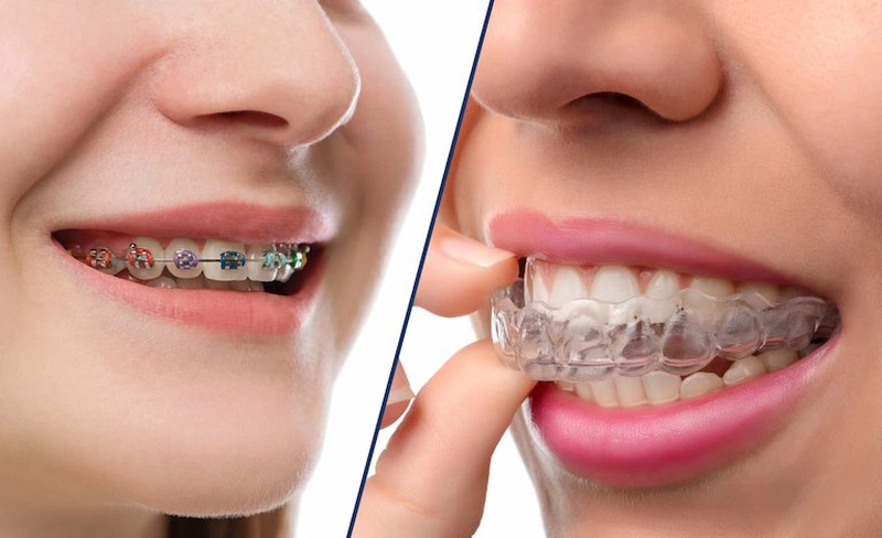 Có nhiều phương pháp niềng răng bạn có thể làm cằm bớt lẹm