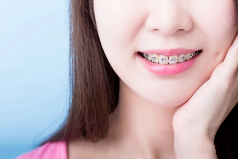 Niềng răng có làm răng bị yếu đi hay không 1