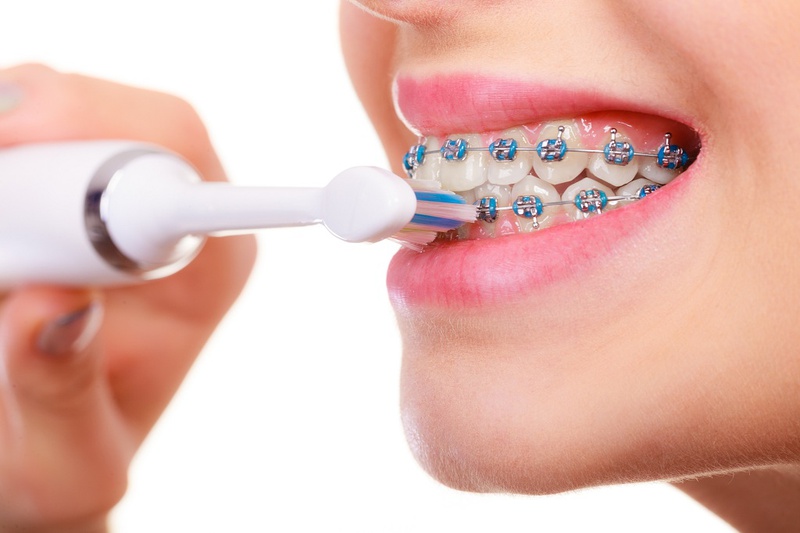 Niềng răng có làm răng bị yếu đi hay không 3