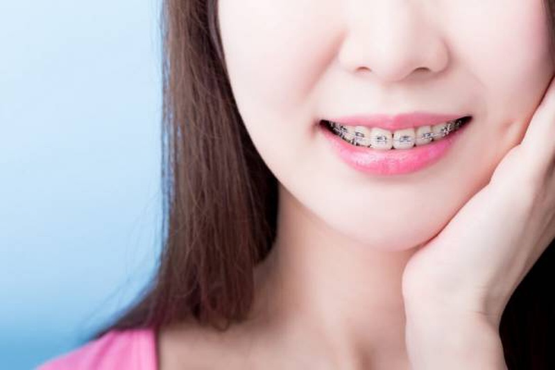 Giải đáp thắc mắc: Niềng răng có làm răng yếu đi không? 1