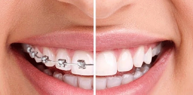 Niềng Răng Là Gì? Niềng Răng Có Quan Hệ Bằng Miệng Được Không? 3