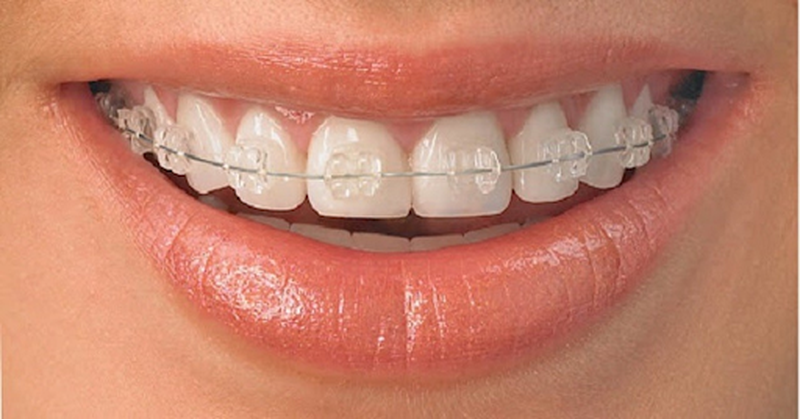 Giải đáp thắc mắc liệu có cách nào để niềng răng giá sinh viên hay không? 2
