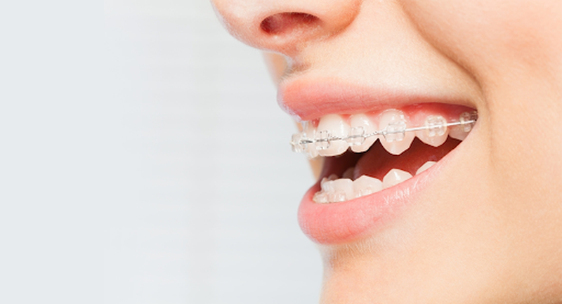 Góc giải đáp các phương pháp niềng răng hô hiệu quả và an toàn là gì? 2