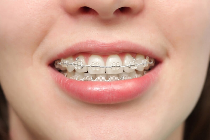 Có nên niềng răng hô nhẹ không?1